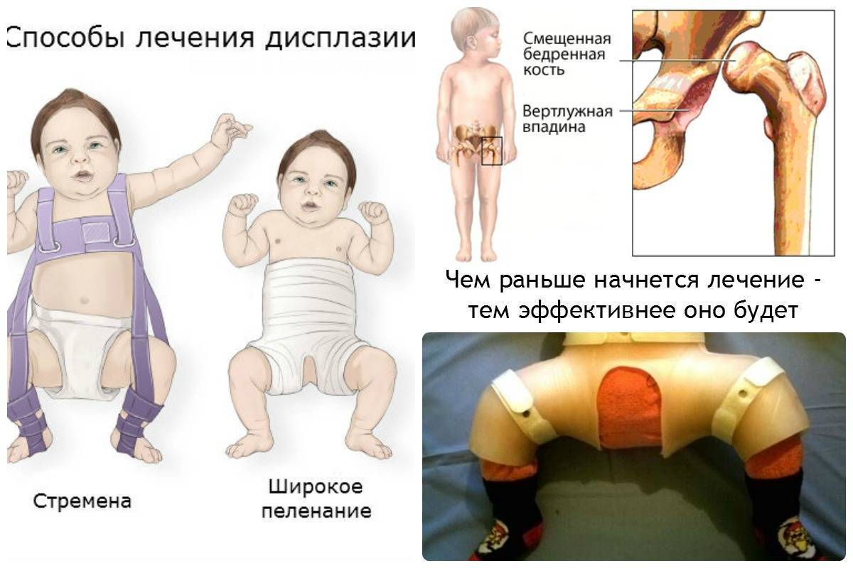 Ограниченность движений в тазобедренном суставе: легко заметить во время пеленания или переодевания, ножки ребенка «не раскрываются»