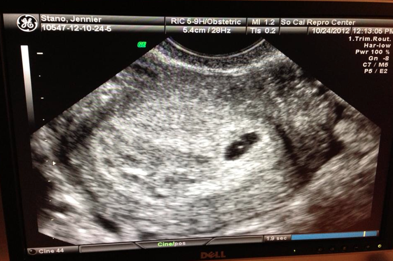 Фото узи на 5 неделе. Плод на 5 неделе беременности УЗИ. Эмбрион на 5 неделе беременности фото УЗИ. Снимок УЗИ на 5 неделе беременности.