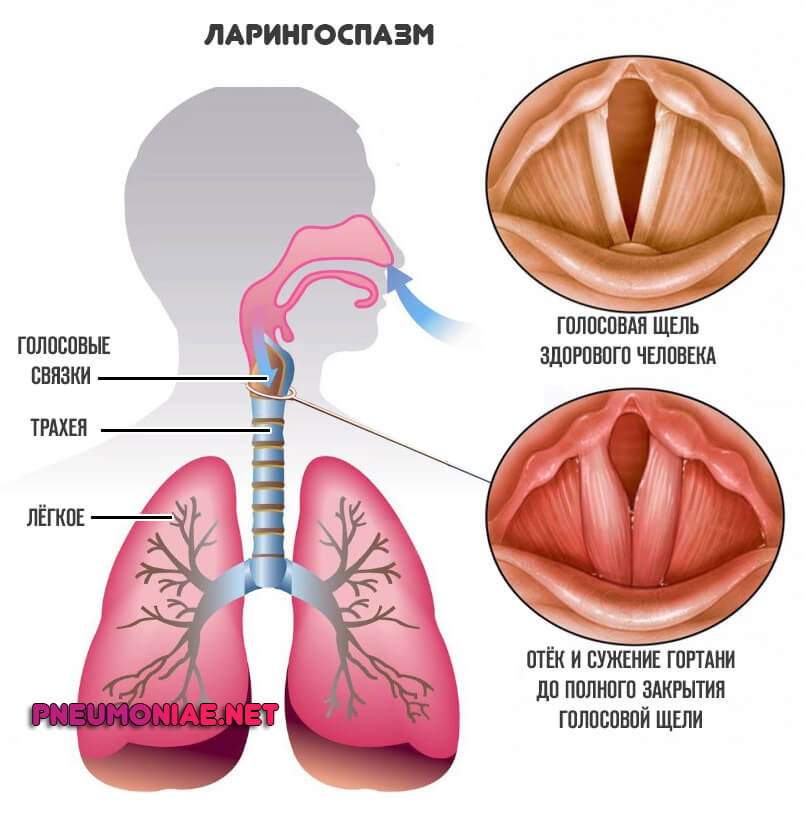 Ларингоспазм у детей презентация
