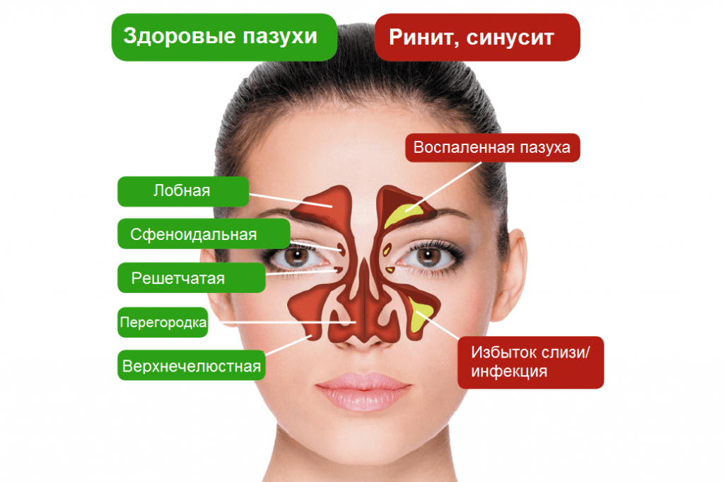 Чем опасна простуда на ранних сроках беременности: риски и последствия