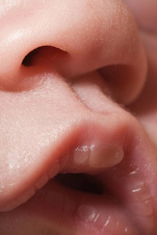 Мозоль на губе у новорожденного: причины появления и методы лечения