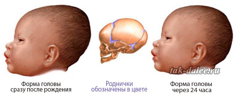 Как выглядит впалый родничок у младенца, что это значит и почему родничок у новорожденнога западает