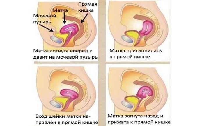 Опущение матки и беременность