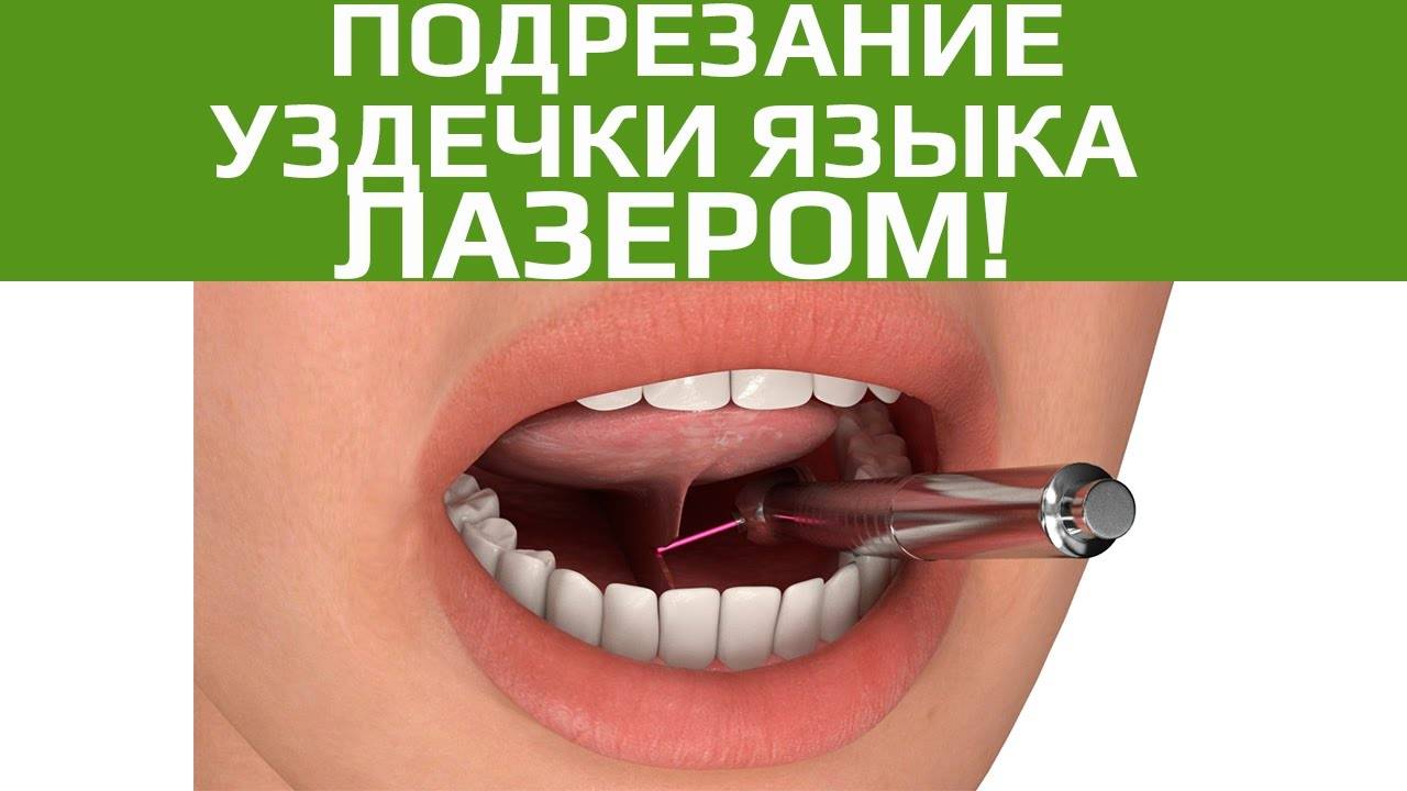 Пластика уздечки верхней губы: показания, описание операции | food and health