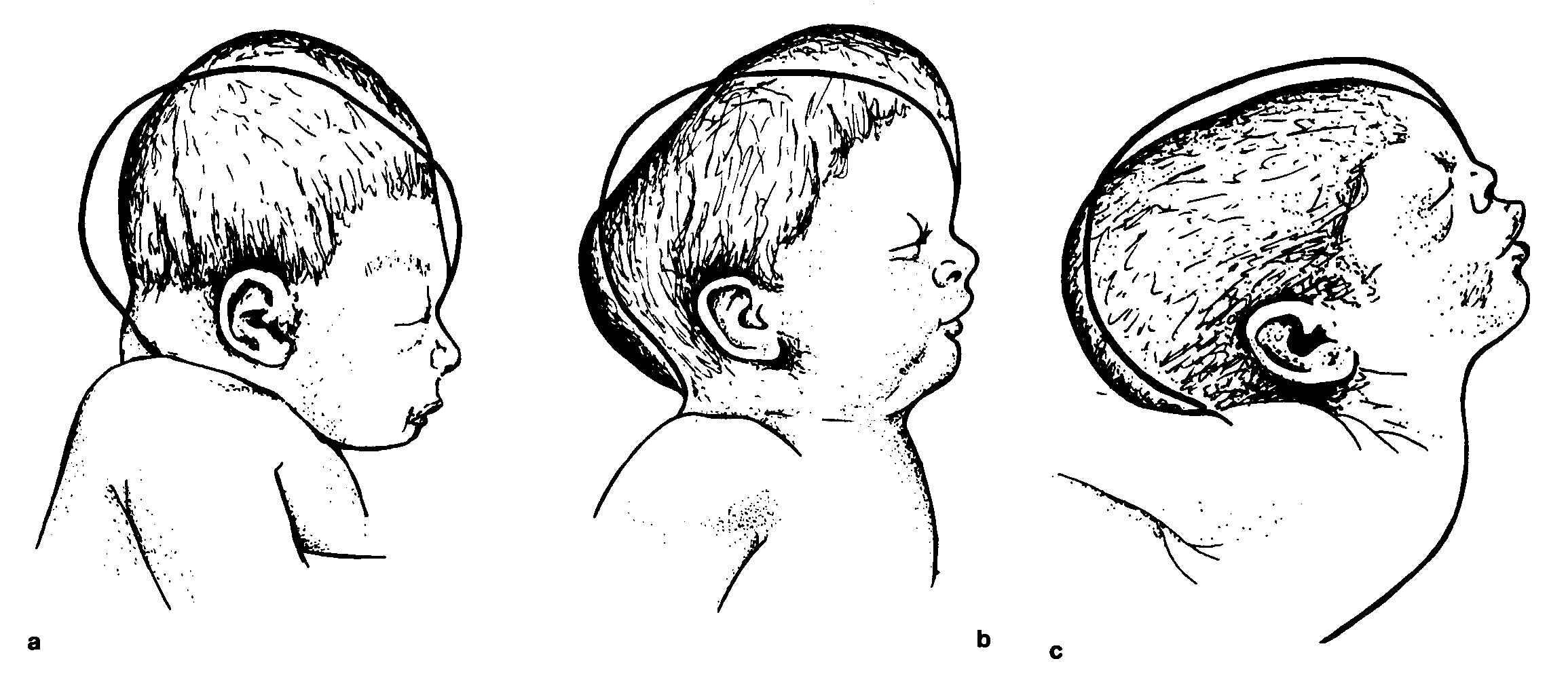 Затылок новорожденного. Долихоцефалическая форма головы новорожденного. Долихоцефалическая форма головы у плода. Кефалогематома пункция. Рахит облысение затылка.