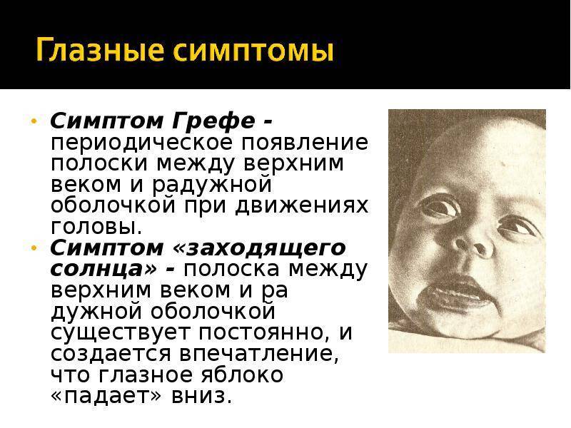 Синдром грефе у новорожденных фото