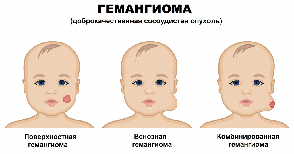 Виды гемангиом у новорожденных, причины возникновения и лечение