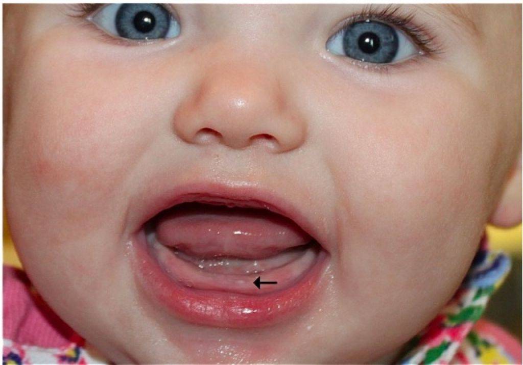 Прорезывание зубов у детей: сроки и последовательность прорезывания временных и постоянных зубов, патологии процесса. признаки того, что у младенца режутся зубы.
