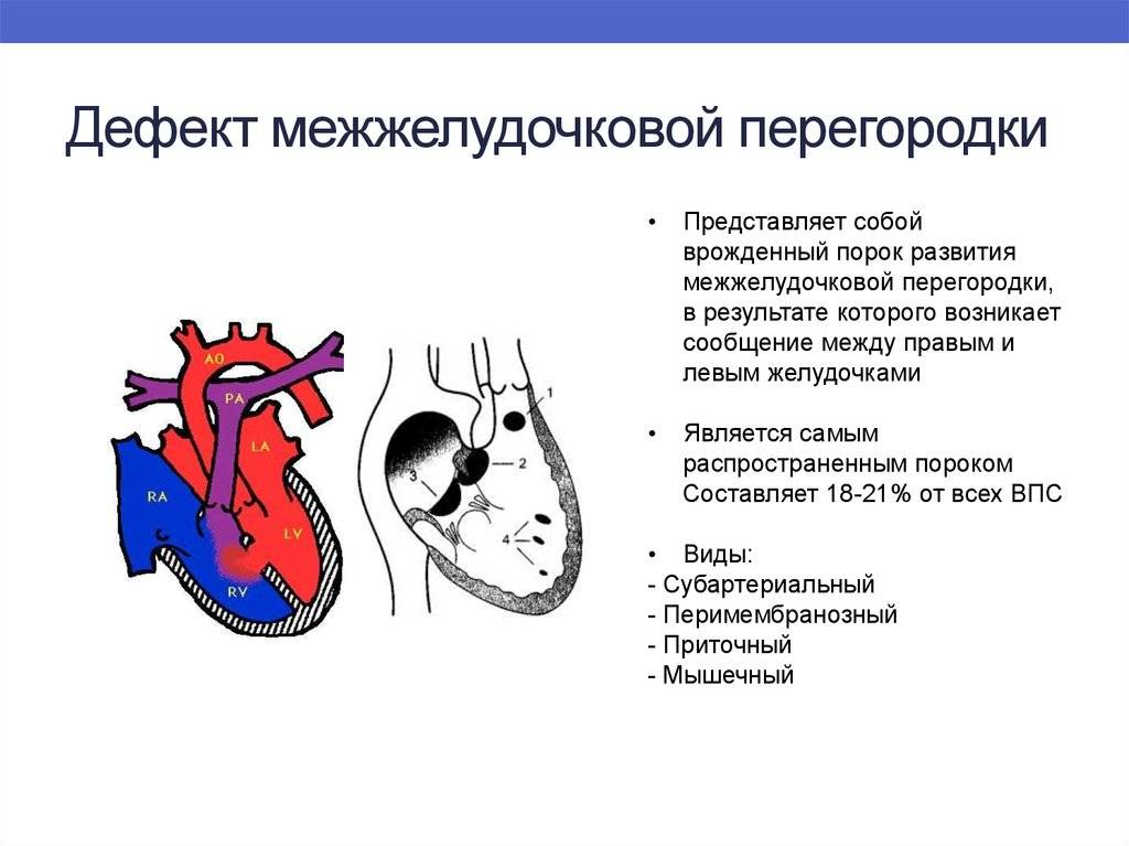 Врожденный порок сердца - симптомы, лечение, причины болезни, первые признаки