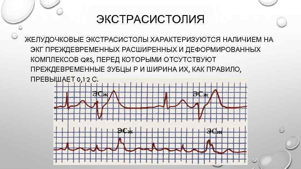 Желудочковая экстрасистолия на экг фото