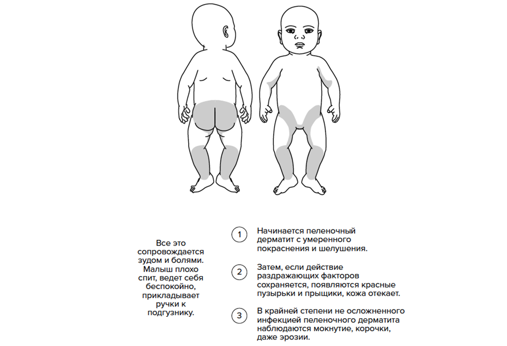 Пеленочный дерматит у детей: причины, симптомы и лечение