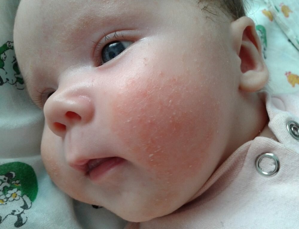 Акне новорожденных: как распознать и не спутать с аллергией