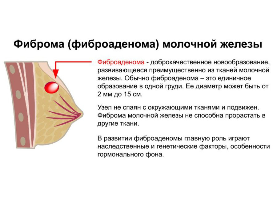 Лактостаз груди у кормящей матери: симптомы, лечение в домашних условиях | nutrilak