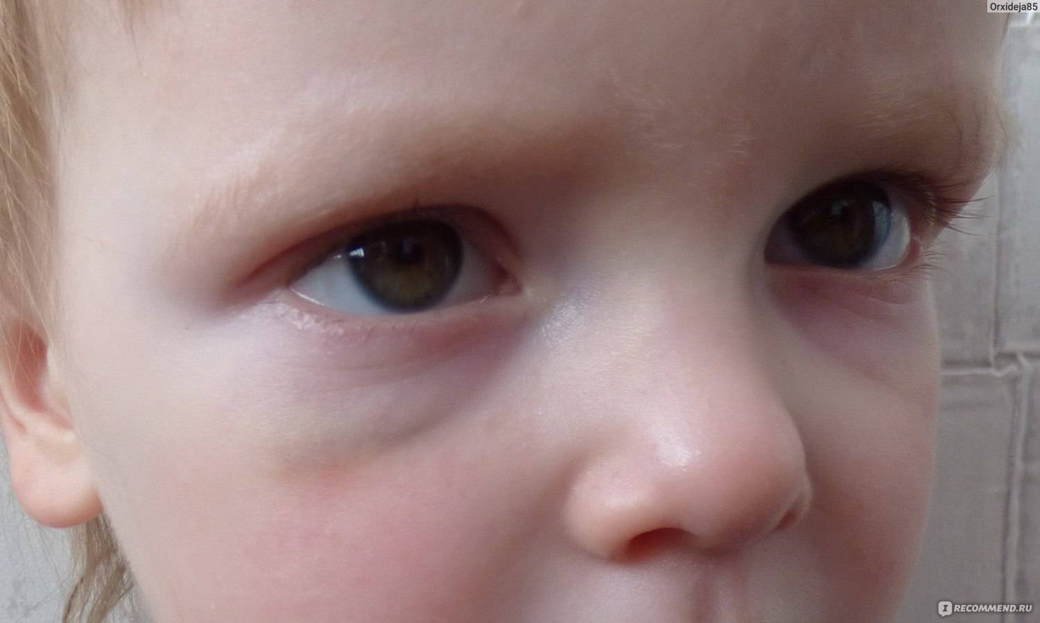 Синяки под глазами у ребенка: основные причины почему они возникают и советы комаровского по лечению и профилактике у детей 1-2 лет и взрослее