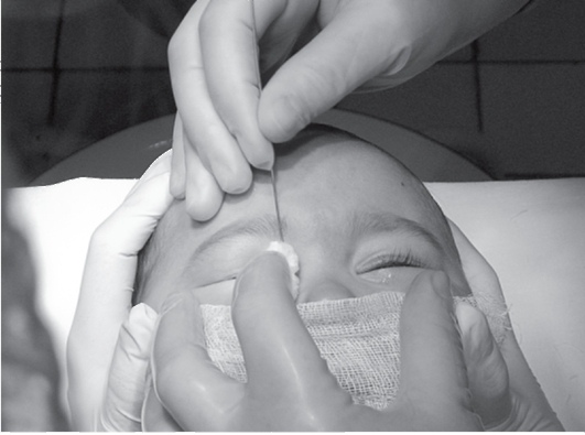 ᐈ зондирование слезного канала у новорожденных в киеве
